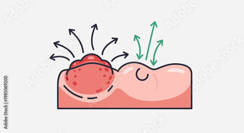 Diagrammatic representation of a malignant melanoma tumor on human skin, showing rapid cell proliferation and metastasis via black arrows, with epidermal expansion indicated by green arrows,