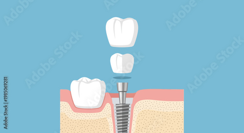 Detailed flat graphic representation of a dental implant process showing tooth crown, abutment, and screw implant with gingiva on blue background