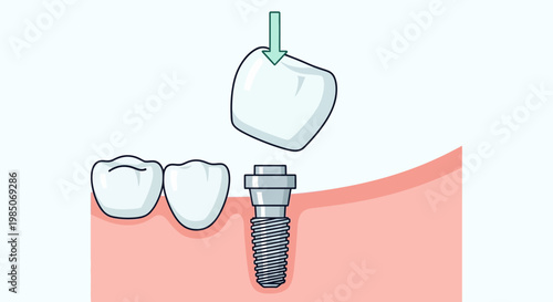 Close-up vector graphic depicting dental implant placement, showing a metal screw abutment, a tooth crown being lowered by an arrow, and two natural teeth in a simplified, clean, medical dia
