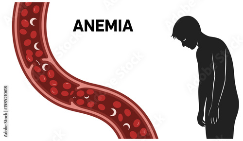 Medical illustration of anemia showing low red blood cell count in a blood vessel and a fatigued male silhouette.