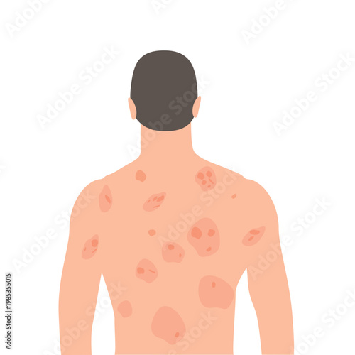 Illustration depicting a man from behind with common skin conditions such as acne, eczema, and psoriasis to reduce inflammation.