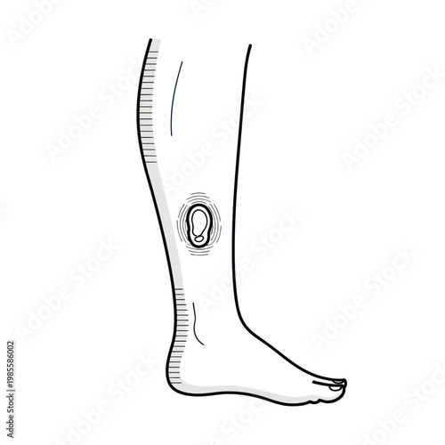 Illustration of a human leg with an insect bite mark on the calf