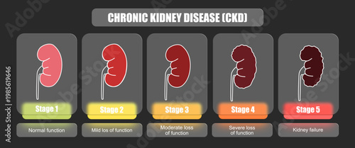 Illustration of chronic kidney disease. Stages of kidney failure in the human body. vector glass effect, illustrations for medical, education, posters, or health elements.