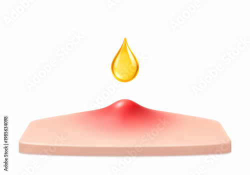 Acne pimple treatment with cosmetic serum drop. Inflamed skin blemish care concept. Dermatology skincare. Realistic vector illustration