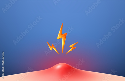 Painful acne pimple inflammation on skin. Dermatology irritation and skin problem concept. Realistic vector illustration