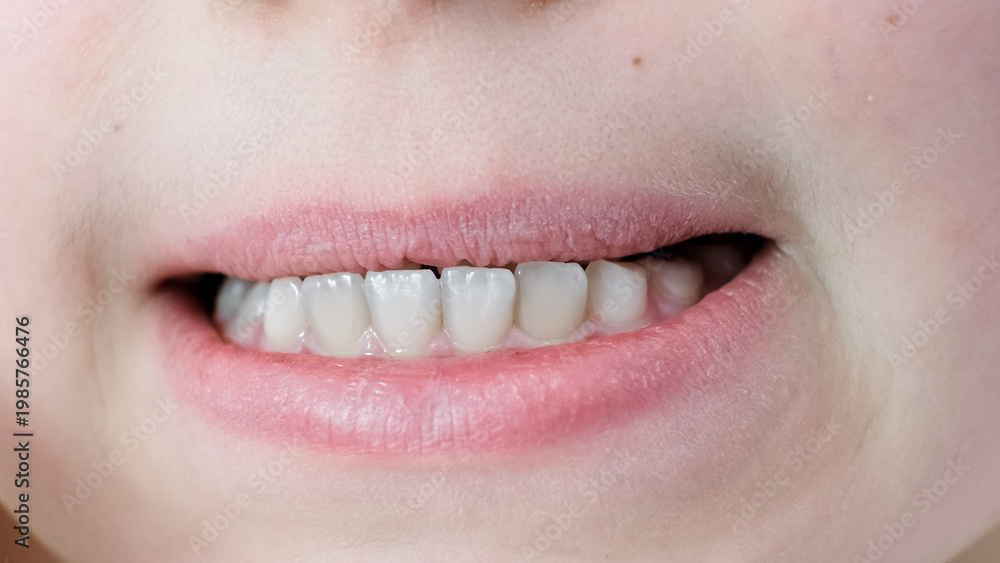 Obraz premium Mesial occlusion. Close-up childs mouth with clean white molars teeth with gap and healthy gums. Ten year age caucasian kid with closely spaced teeth. Upper teeth behind lower. Plaque on enamel.