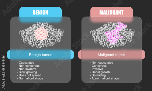 Vector illustration of malignant and benign tumors in body tissues. Difference between malignant and benign tumors, Spread of cancer cells. Glass effect illustration for education, posters, clinics,