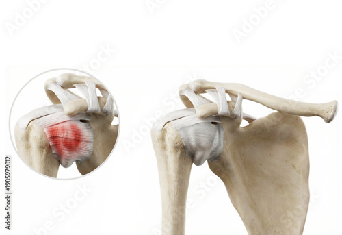 Frozen Shoulder. Medical Illustration Showing Inflammation and Fibrosis of the Shoulder Capsule.