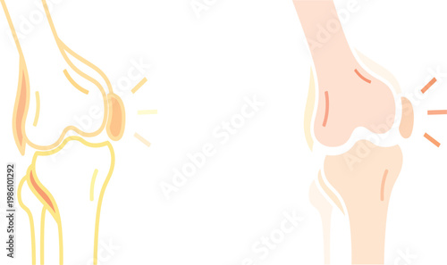 Human Knee Joint Pain and Inflammation Vector Set Featuring Patella Ache Symbols in Flat Color and Outline Styles for Medical Healthcare and Orthopedic Education Designs