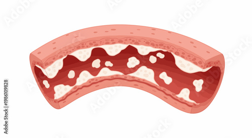 Cross-section of a blood vessel with plaque buildup within the lumen