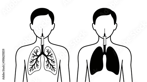 Diagrams illustrating human lungs within a torso, one showing the bronchial tree, the other filled lungs.