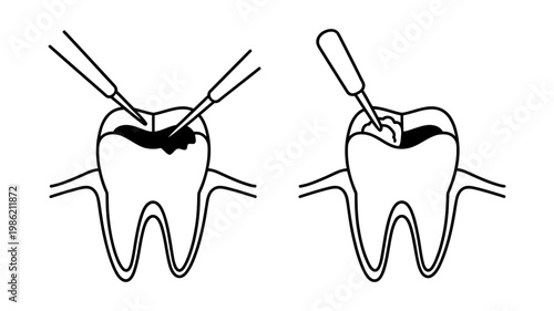 Dental illustrations demonstrating the process of a tooth cavity filling, from decay removal to restoration.