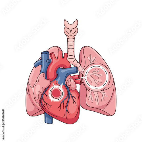 Medical vector illustration of human respiratory and circulatory systems showing heart and lungs with highlighted areas representing pulmonary hypertension and vascular disease.
