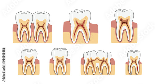 Educational diagram showing different types of human teeth and various stages of dental decay from healthy to deep cavities and gum issues.
