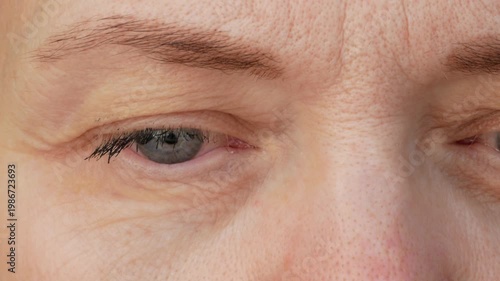 middle aged female's eye with drooping eyelid and cream cosmetic for the skin around the eyes. Ptosis is a drooping of the upper eyelid, lazy eye. Cosmetology and facial