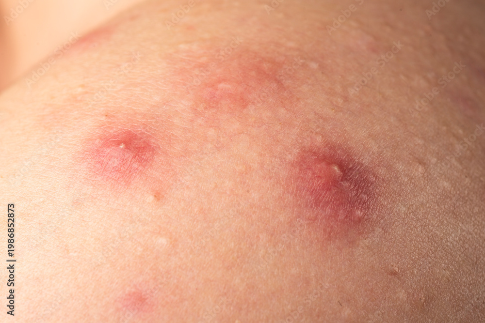 Fototapeta premium Macro shot of skin irritation with acne. Close up epidermis with inflamed follicles and acne. Skin rash texture with acne. Detailed skin with acne.