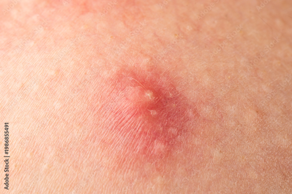 Fototapeta premium Close up epidermis with inflamed follicles and acne. Skin rash texture with acne. Inflamed skin bumps acne macro. Detailed skin with acne.
