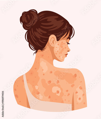 Vector illustration of a woman from behind, with visible skin imperfections acne, vitiligo, and other blemishes. Ideal for dermatology, skincare, cosmetology, health awareness, body positivity