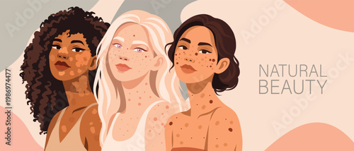 Natural beauty. Vector illustration, three different women with natural skin textures vitiligo, albinism, freckles, skin imperfections. For body positivity, self-acceptance, self-care, mental health
