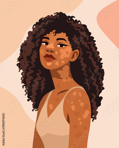 Vitiligo Natural Beauty. Vector portrait of a confident African American woman with curly hair and vitiligo. Perfect for campaigns celebrating diversity, self-acceptance, skincare, and body positivity