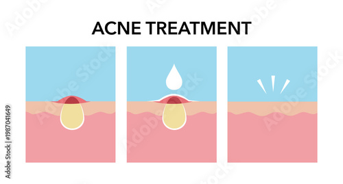 Treatment of acne. Skin layers before, during and after treatment. Acne skin and healthy skin. Treating acne with acne serum.