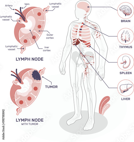 Lymphatic system anatomy and lymph node structure with tumor illustration