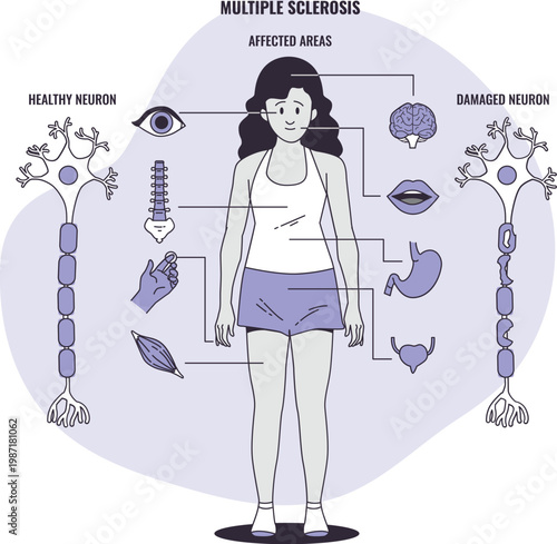 Multiple sclerosis infographic showing healthy and damaged neurons and affected human body parts