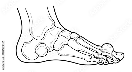 Gout Joint Inflammation in Human Foot Vector Illustration, Medical Anatomy Diagram Showing Metatarsophalangeal Joint Swelling for Orthopedic Health Education