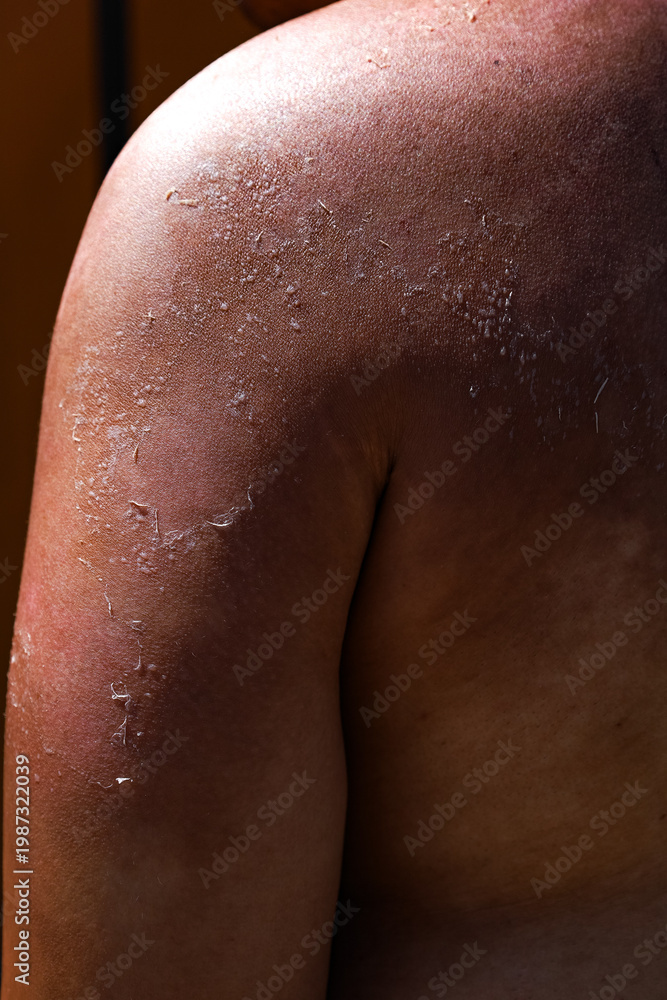 Naklejka premium Close Up Dermatology of Peeling Sunburned Skin on Shoulder Body Part