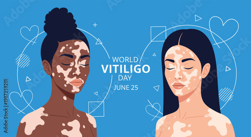Two beautiful women with vitiligo are depicted against a blue background with hearts to celebrate World Vitiligo Day on June 25.