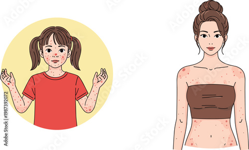 Chickenpox Skin Rash Illustration Showing Child and Adult with Red Spots, Viral Infection Symptoms, Dermatology Condition, and Healthcare Awareness Concept