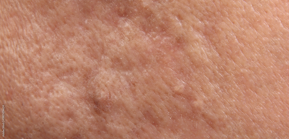 Fototapeta premium Blackheads acne. Macro close up image of facial skin and nose. showing visible pores blackheads acne marks and skin texture. Ideal for skincare dermatology cosmetic treatment and skin health concepts