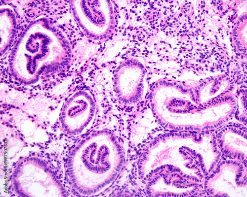 Human endometrium. Hyperplasia