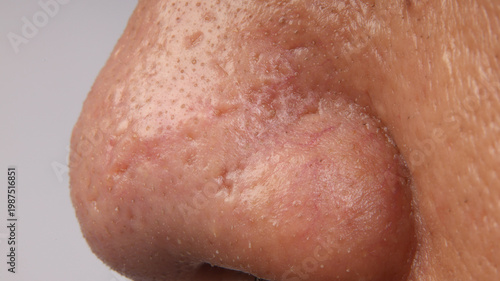 a human nose showing severe skin problems
