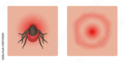 Tick Bite with Erythema and Bite Mark. Signs of Lyme Disease. Vector Illustration