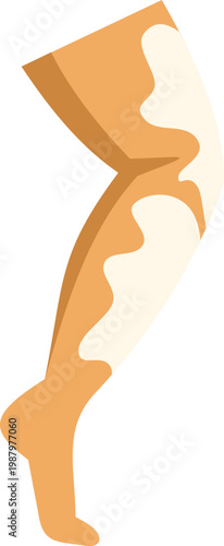 Lower limb affected by vitiligo showing white patches of depigmentation