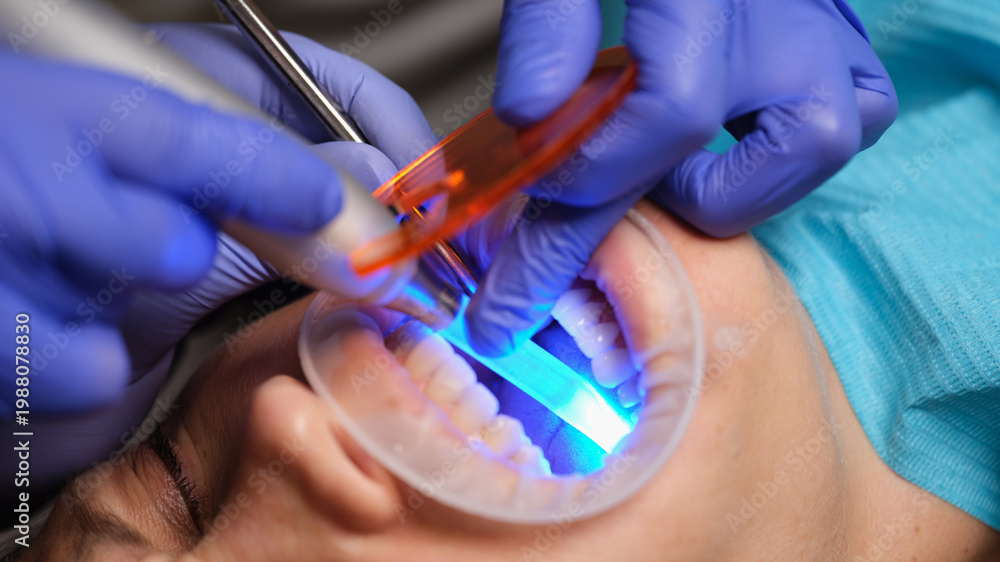 Αυτοκόλλητο In a modern dental clinic, a professional performs a teeth whitening treatment using a blue light through a protective barrier