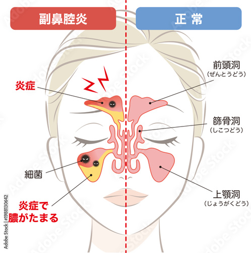 副鼻腔炎の鼻腔と正常な鼻腔