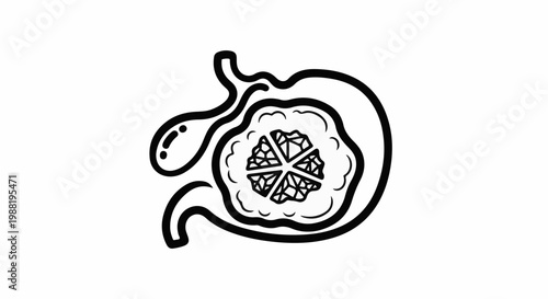 Stylized illustration of a cross-section of a stomach containing a segmented, crystalline growth