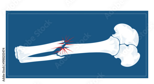 Illustration of a fractured bone with highlighted break on a blue background, resembling an X-ray image with sharp lines and detailed structure