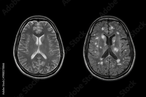 Normal Brain MRI vs Multiple Sclerosis Plaques Comparison