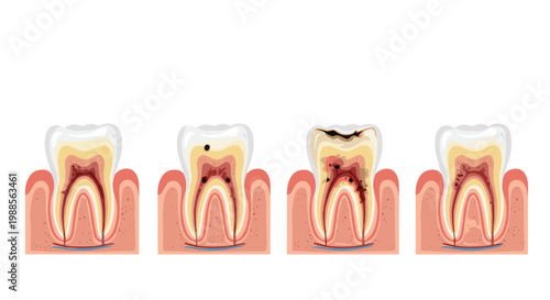 Medical illustration showing the different stages of tooth decay from a small cavity to deep infection within the root.
