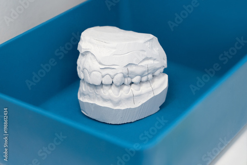 Dental plaster cast of human jaw in tray for orthodontic treatment and prosthetic planning. Gypsum tooth impression model for stomatology laboratory and professional diagnostic concept.
