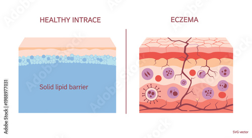 Comparing healthy skin layers with eczema diagram