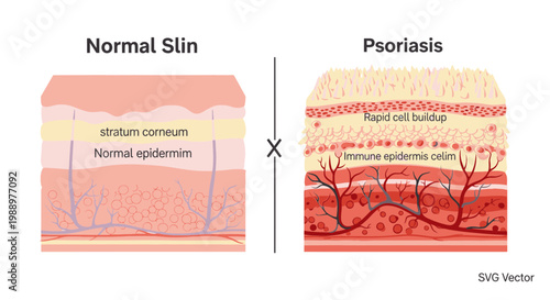 Comparing Normal Skin Layers and Psoriasis Affected Skin Diagram