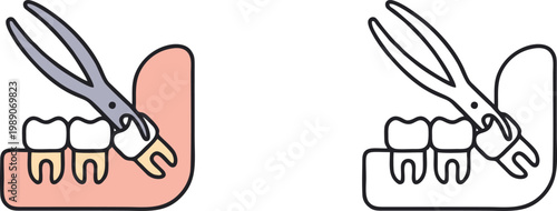 Tooth Extraction Procedure With Dental Forceps Illustration