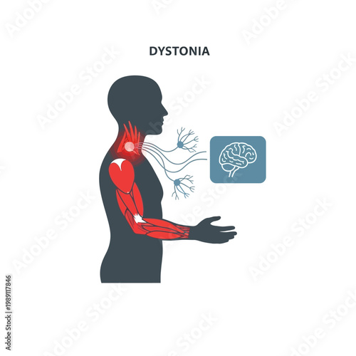 Illustration depicting dystonia, a neurological movement disorder, showing affected muscles and the brain's role in its pathology.