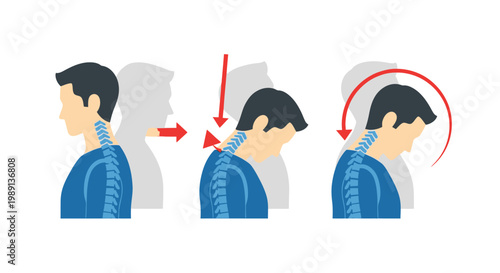 Visual guide illustrating forward head posture progression and strain on the human cervical spine.