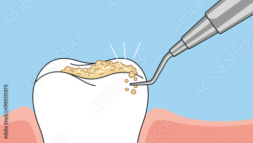 Professional dental tool being used to remove yellow plaque and tartar buildup from a white molar tooth for oral cleaning.