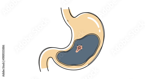 Illustration of a human stomach showing an internal ulcer or lesion.